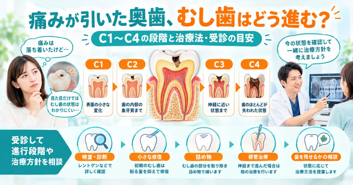 痛みが引いた奥歯のむし歯は？進行段階C1〜C4と治療法・受診目安