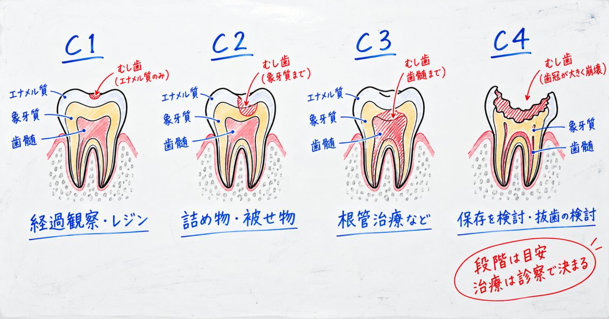 むし歯の進行段階C1〜C4と治療法の違い