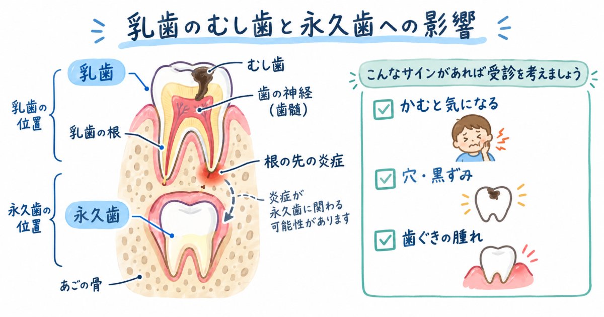 乳歯のむし歯を放置すると永久歯に起こる影響と受診を考えるサイン