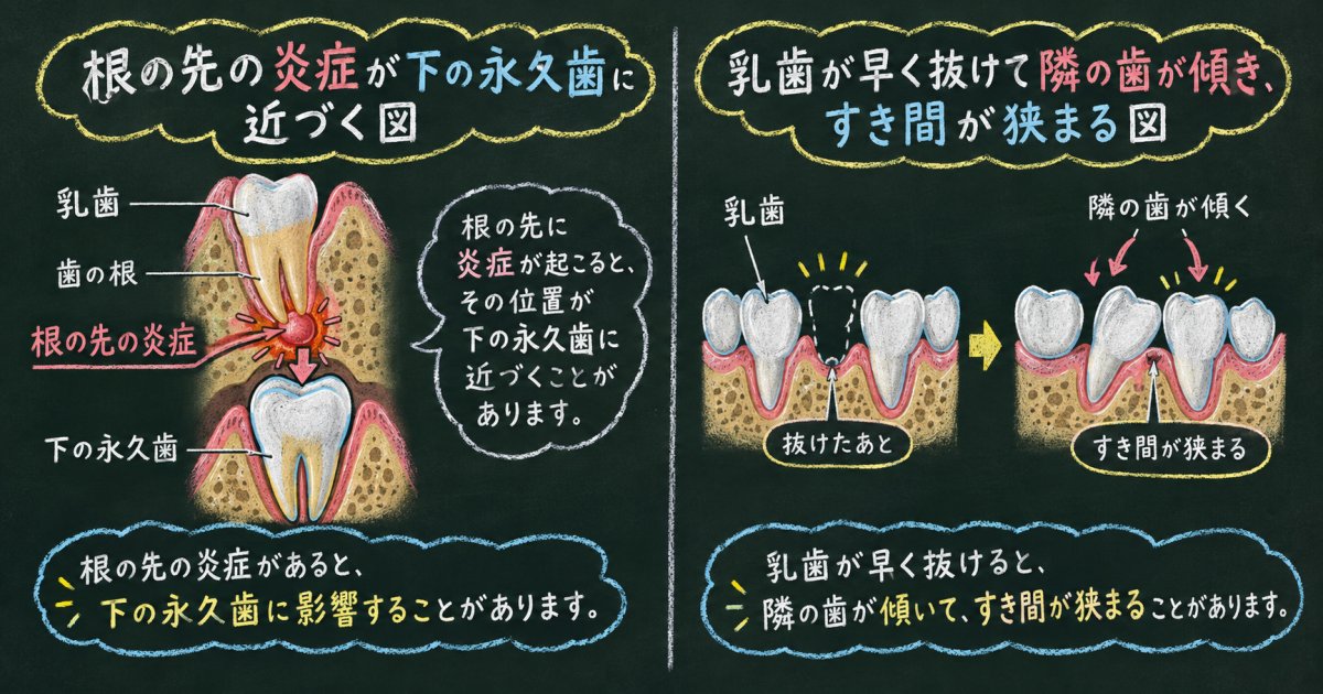 乳歯のむし歯を放置すると永久歯に起こり得る影響とその仕組み